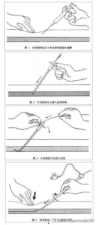 深静脉穿刺视频